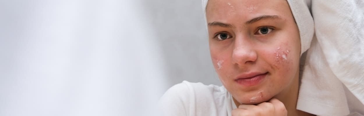 Garota adolescente com toalha na cabeça, olhando no espelho com creme para acne no rosto, pensando o que causa espinhas.