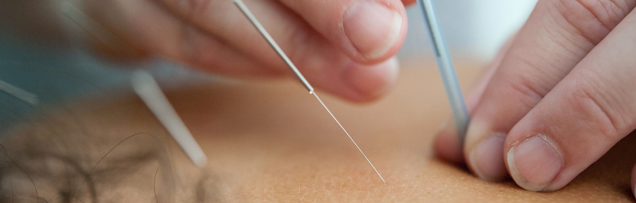 Close de uma aplicação de agulhas de acupuntura nas costas de uma paciente