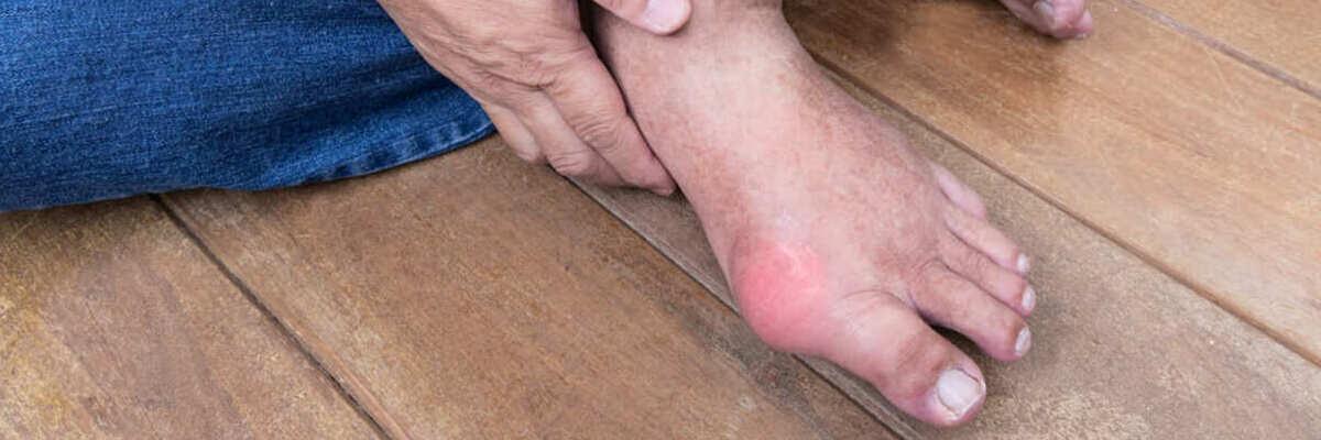Homem em um chão de madeira abraçando pé inflamado com gota, uma das doenças associadas ao excesso de ácido úrico. 