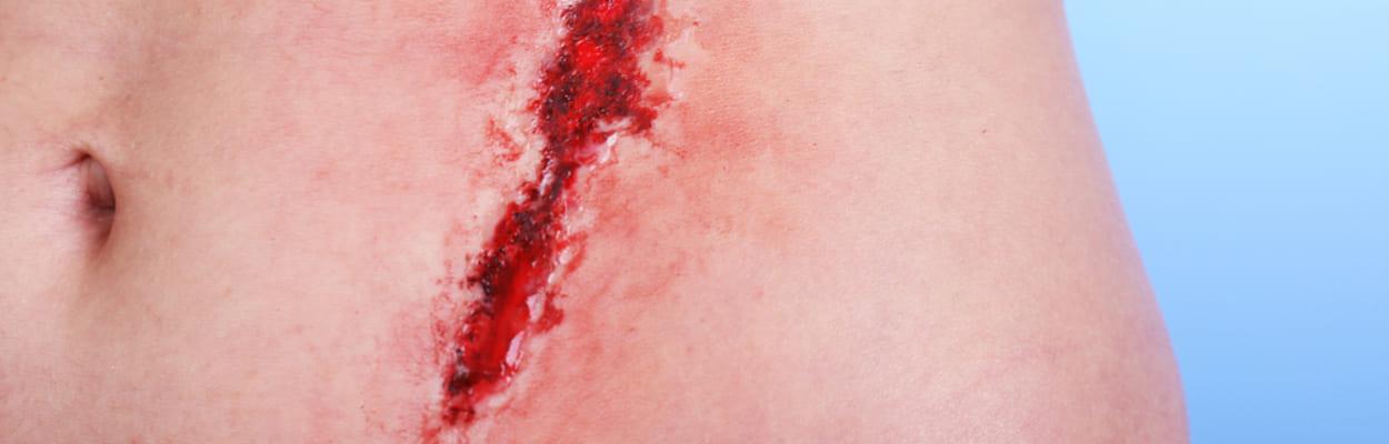  Foto da barriga de uma mulher com um grande machucado do lado direito, representando alimentos que podem ajudar na cicatrização de feridas.