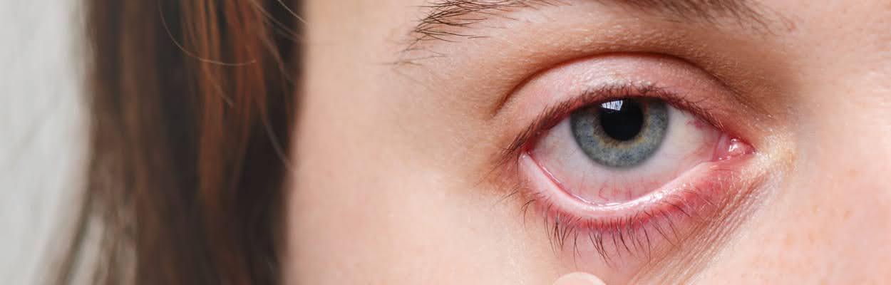 Mulher apontando para o olho que está vermelho devido à conjuntivite. A imagem representa os sintomas de conjuntivite.